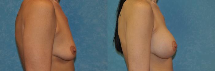 Before & After Breast Augmentation Case 400 Right Side View in Toledo, Ohio