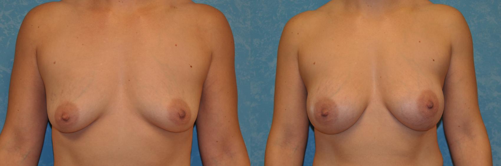Before & After Breast Augmentation Case 421 Front View in Toledo, Ohio