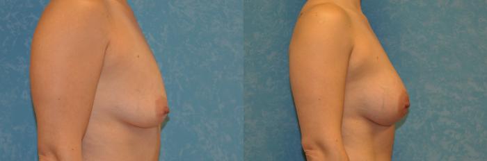 Before & After Breast Augmentation Case 421 Right Side View in Toledo, Ohio