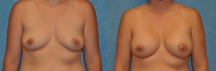 Before & After Breast Augmentation Case 425 Front View in Toledo, Ohio