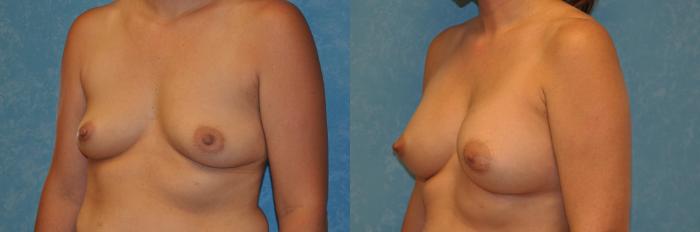 Before & After Breast Augmentation Case 425 Left Oblique View in Toledo, Ohio