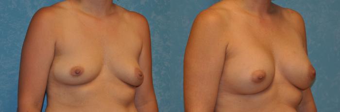 Before & After Breast Augmentation Case 425 Right Oblique View in Toledo, Ohio