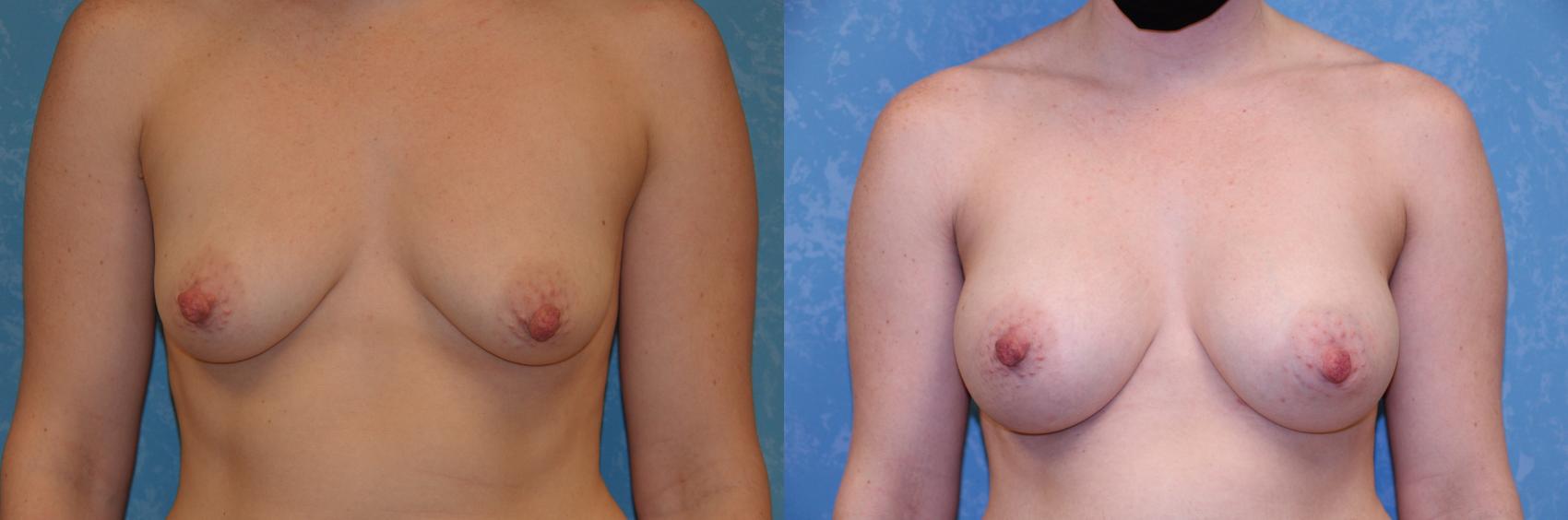 Before & After Breast Augmentation Case 427 Front View in Toledo, Ohio