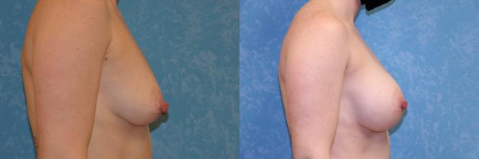 Before & After Breast Augmentation Case 427 Right Side View in Toledo, Ohio