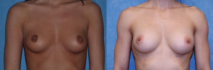 Before & After Breast Augmentation Case 428 Front View in Toledo, Ohio