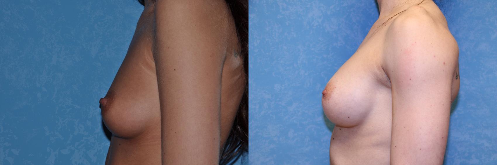 Before & After Breast Augmentation Case 428 Left Side View in Toledo, Ohio