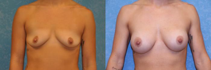 Before & After Breast Augmentation Case 429 Front View in Toledo, Ohio