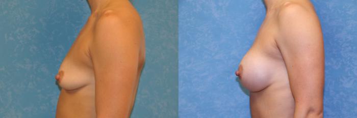 Before & After Breast Augmentation Case 429 Left Side View in Toledo, Ohio