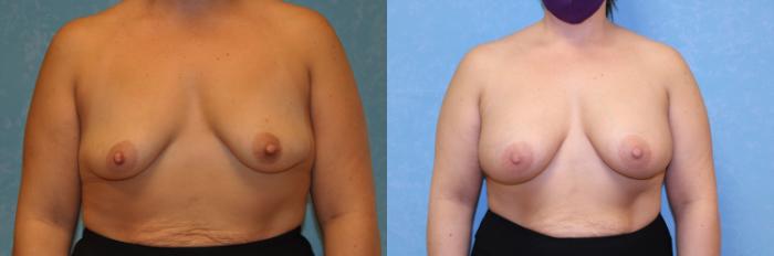 Before & After Breast Augmentation Case 430 Front View in Toledo, Ohio