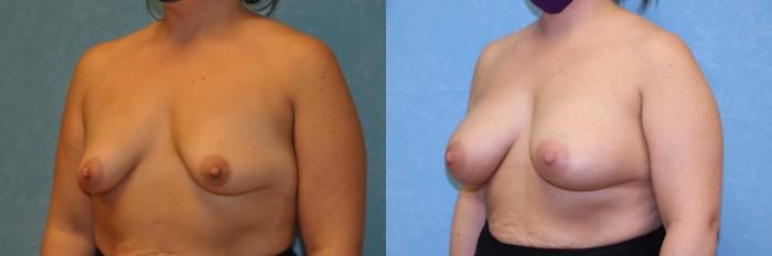 Before & After Breast Augmentation Case 430 Left Oblique View in Toledo, Ohio