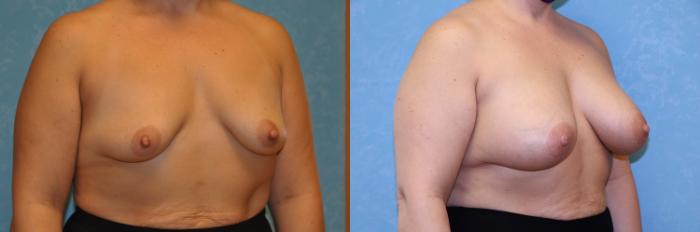 Before & After Breast Augmentation Case 430 Right Oblique View in Toledo, Ohio