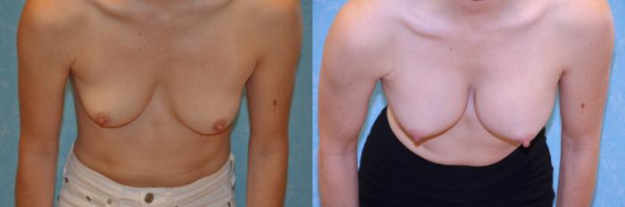 Before & After Breast Augmentation Case 431 Bent Forward View in Toledo, Ohio