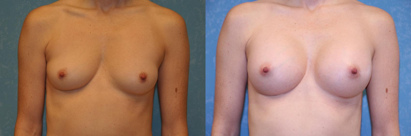 Before & After Breast Augmentation Case 431 Front View in Toledo, Ohio