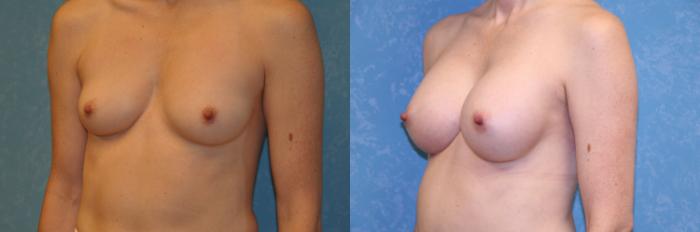 Before & After Breast Augmentation Case 431 Left Oblique View in Toledo, Ohio