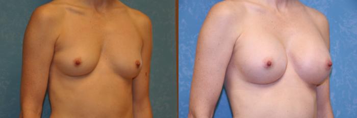 Before & After Breast Augmentation Case 431 Right Oblique View in Toledo, Ohio