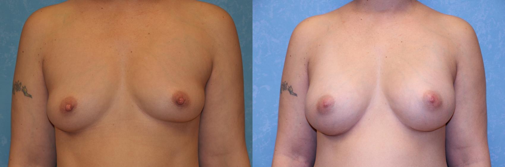 Before & After Breast Augmentation Case 432 Front View in Toledo, Ohio