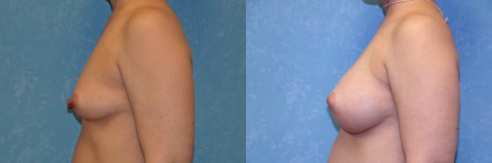 Before & After Breast Augmentation Case 432 Left Side View in Toledo, Ohio