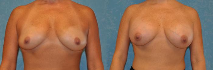 Before & After Breast Augmentation Case 434 Front View in Toledo, Ohio
