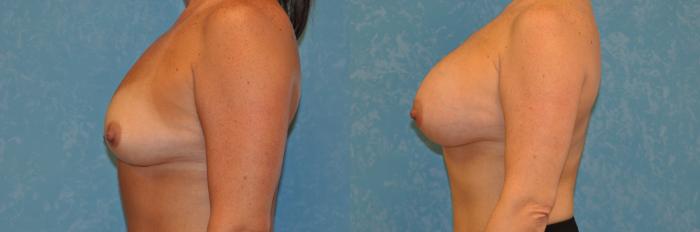 Before & After Breast Augmentation Case 434 Left Side View in Toledo, Ohio