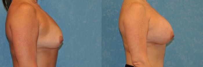 Before & After Breast Augmentation Case 434 Right Side View in Toledo, Ohio