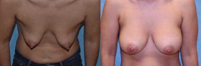 Before & After Breast Augmentation Case 435 Bent Forward View in Toledo, Ohio