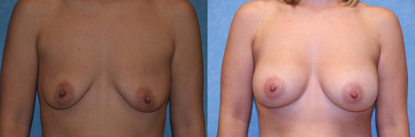 Before & After Breast Augmentation Case 435 Front View in Toledo, Ohio