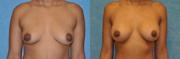 Before & After Breast Augmentation Case 460 Front View in Toledo, Ohio