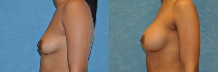 Before & After Breast Augmentation Case 460 Left Side View in Toledo, Ohio