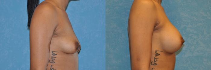 Before & After Breast Augmentation Case 460 Right Side View in Toledo, Ohio