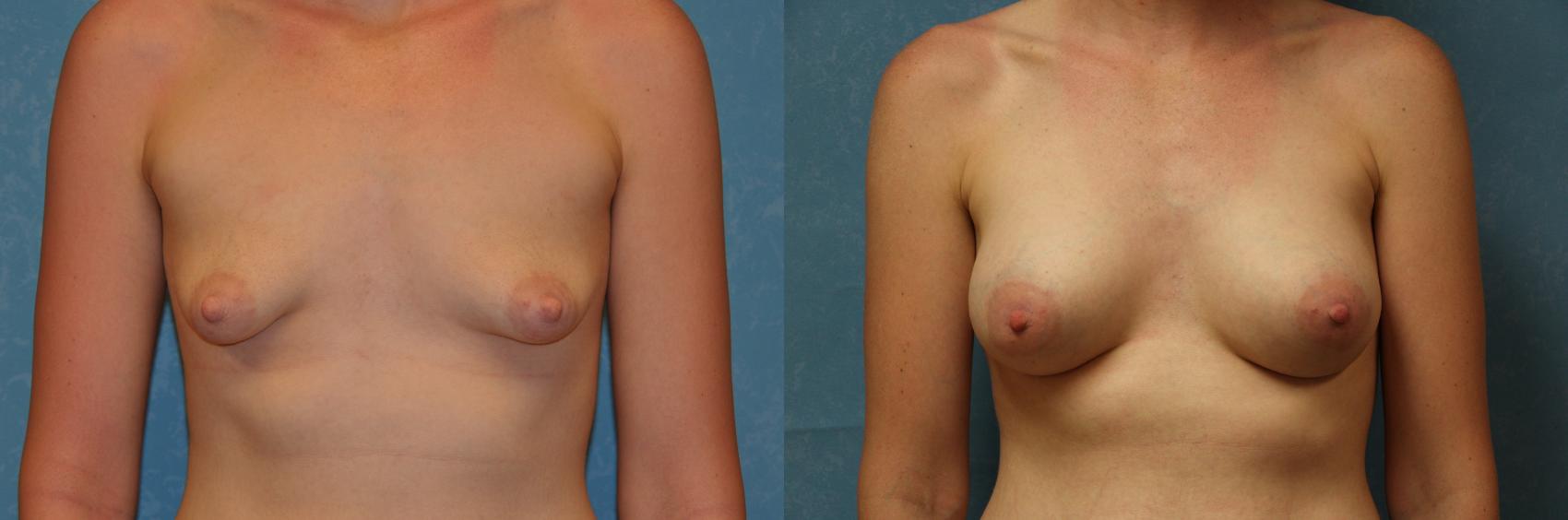 Before & After Breast Augmentation Case 466 Front View in Toledo, Ohio