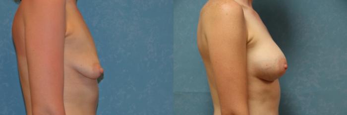 Before & After Breast Augmentation Case 466 Right Side View in Toledo, Ohio