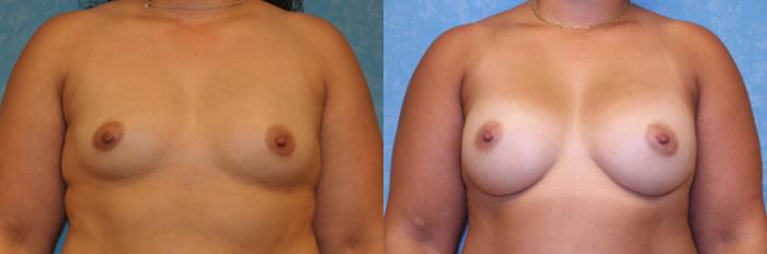 Before & After Breast Augmentation Case 469 Front View in Toledo, Ohio