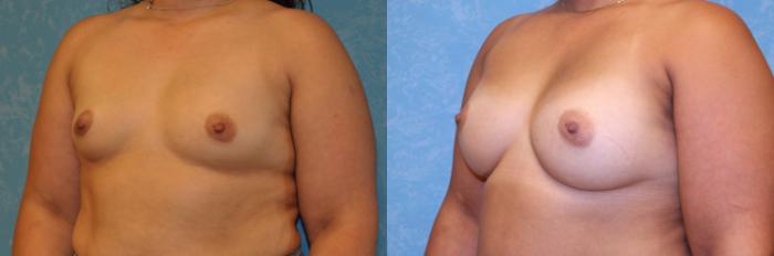 Before & After Breast Augmentation Case 469 Left Oblique View in Toledo, Ohio