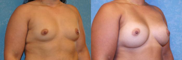 Before & After Breast Augmentation Case 469 Right Oblique View in Toledo, Ohio