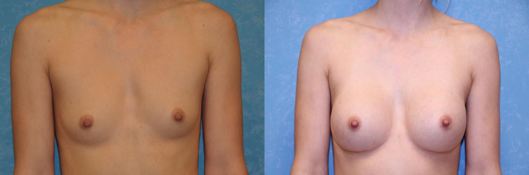 Before & After Breast Augmentation Case 470 Front View in Toledo, Ohio