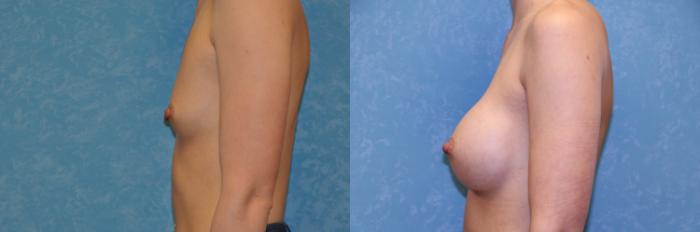Before & After Breast Augmentation Case 470 Left Side View in Toledo, Ohio
