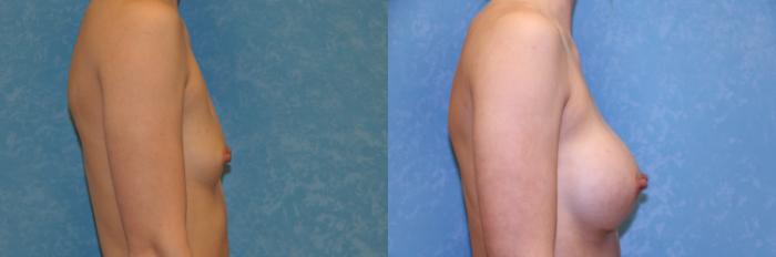 Before & After Breast Augmentation Case 470 Right Side View in Toledo, Ohio