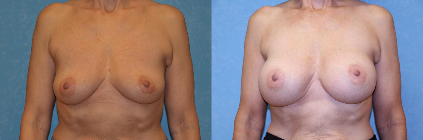 Before & After Breast Augmentation Case 480 Front View in Toledo, Ohio