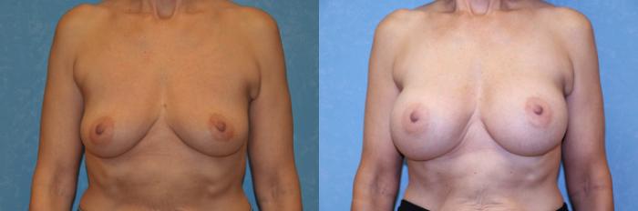 Before & After Breast Augmentation Case 480 Front View in Toledo, Ohio