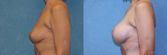 Before & After Breast Augmentation Case 480 Left Side View in Toledo, Ohio