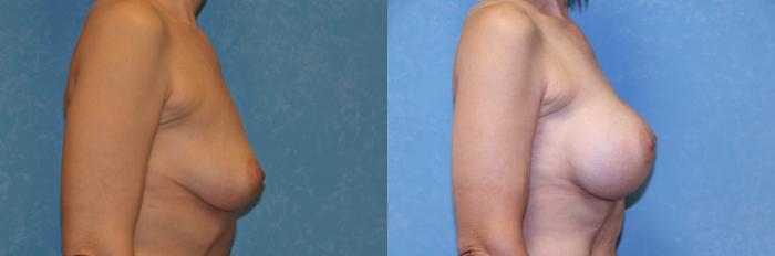 Before & After Breast Augmentation Case 480 Right Side View in Toledo, Ohio