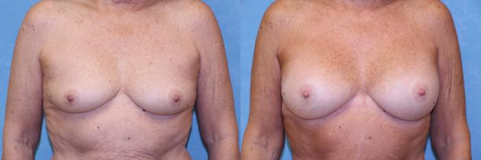 Before & After Breast Augmentation Case 481 Front View in Toledo, Ohio