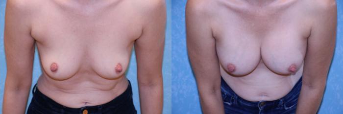 Before & After Breast Augmentation Case 492 Bent Forward View in Toledo, Ohio