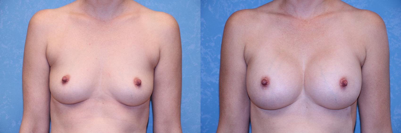 Before & After Breast Augmentation Case 492 Front View in Toledo, Ohio