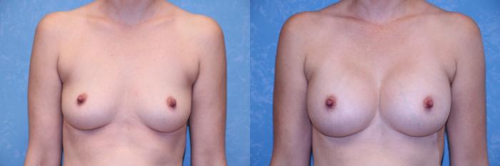Before & After Breast Augmentation Case 492 Front View in Toledo, Ohio