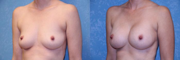 Before & After Breast Augmentation Case 492 Left Oblique View in Toledo, Ohio