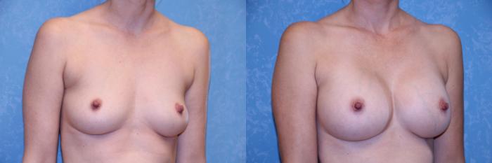 Before & After Breast Augmentation Case 492 Right Oblique View in Toledo, Ohio