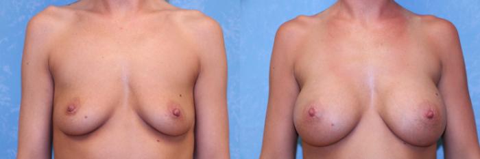 Before & After Breast Augmentation Case 496 Front View in Toledo, Ohio