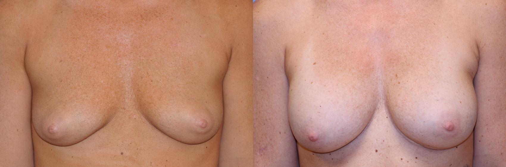 Before & After Breast Augmentation Case 509 Front View in Toledo, Ohio