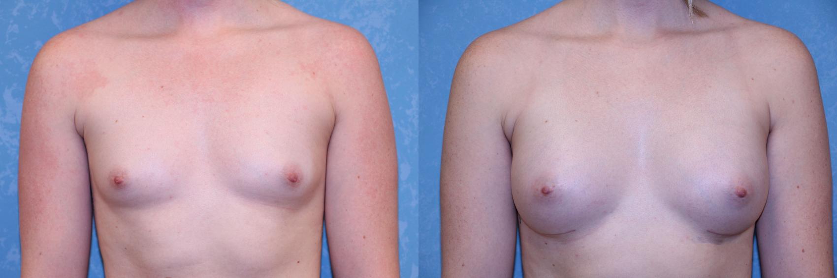 Before & After Breast Augmentation Case 510 Front View in Toledo, Ohio